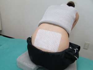 保谷のぎっくり腰治療テーピング